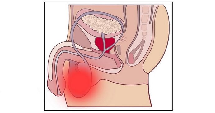 Inflammation of the testicles can be a complication of penis enlargement surgery. 