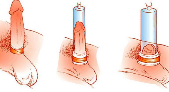 The principle of operation of a vacuum pump suitable for penis enlargement